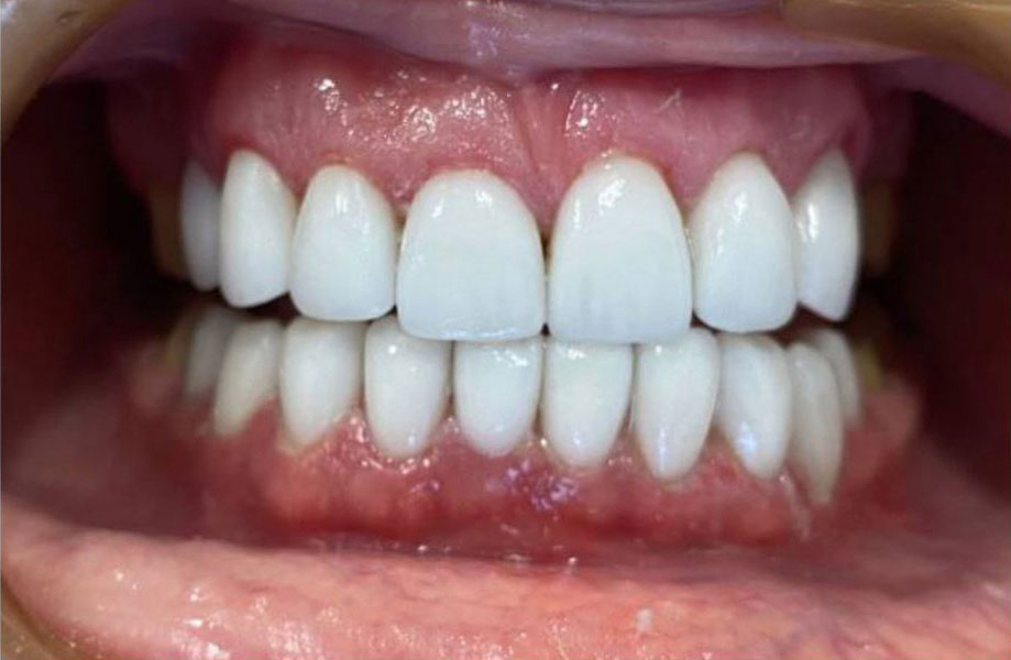 Керамические виниры на зубы