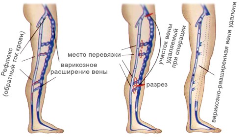 Флебэктомия варикозных вен ног в Москве