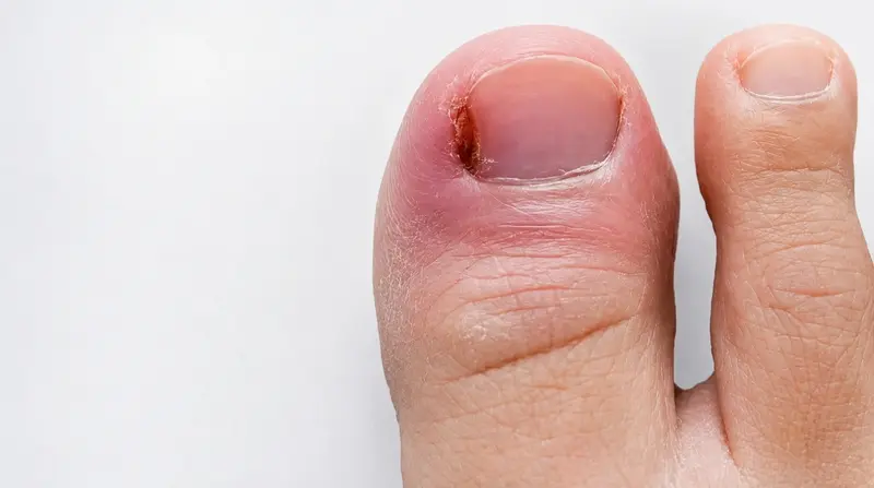 Лечение воспаления у ногтя (панариция)
