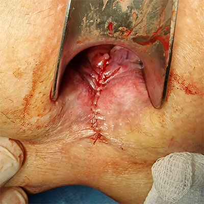 Операция по удалению анальной трещины