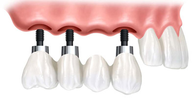 Когда зубные имплантаты являются лучшим вариантом?