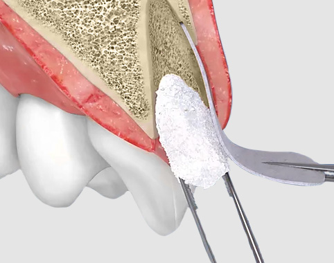 Удаление зубов с к костной пластикой лунки в КДС клиник в Дегунино Западное