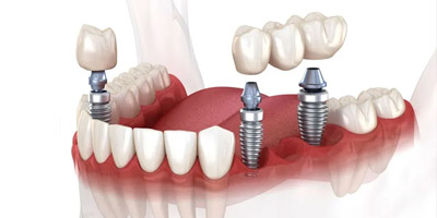 Когда зубные имплантаты являются лучшим вариантом?