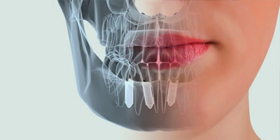 9 распространенных заблуждений о имплантации зубов