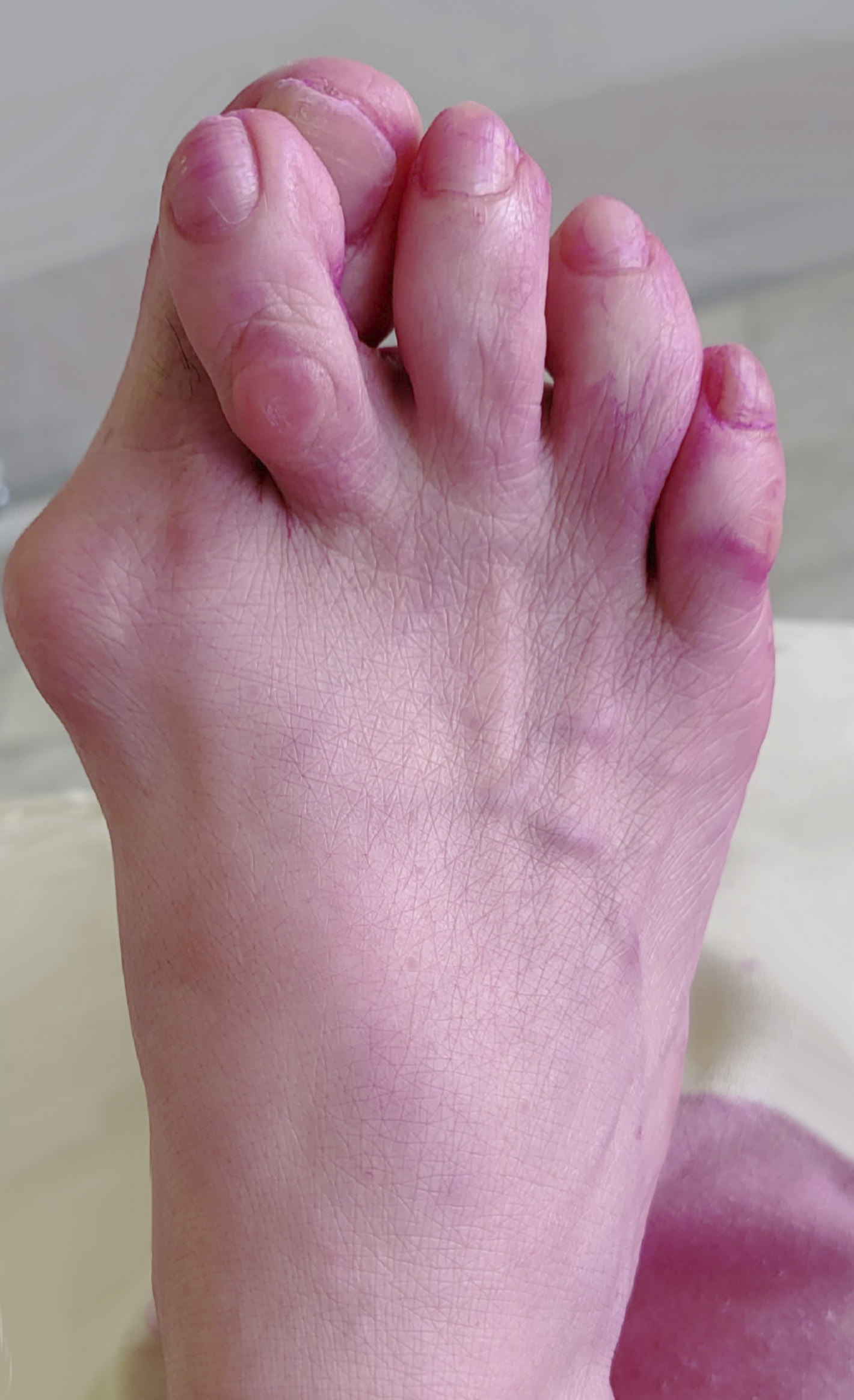 Вальгусная деформация стопы и молоткообразная деформация пальцев до операции