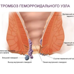 Тромбэктомия геморроидального узла